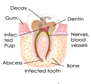 Root Canal Step1