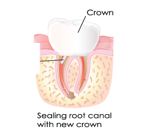 Root Canal Step6