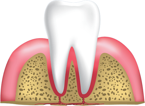 gum disease stage 1