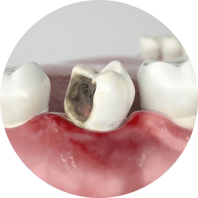 damaged tooth graphic